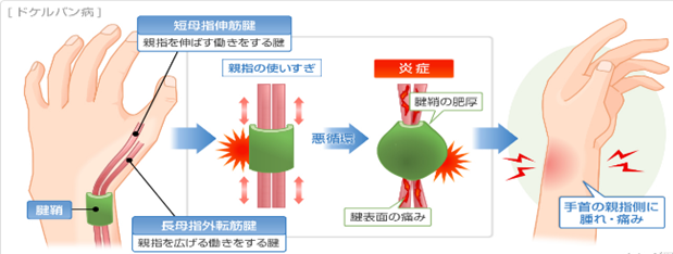 ドケルバン病の症状
