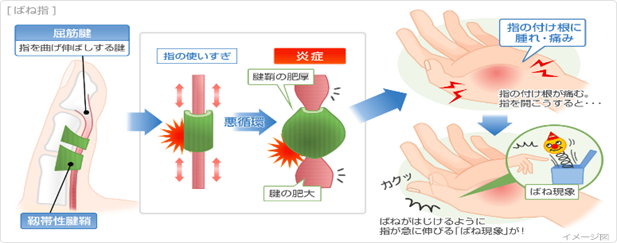 ばね指の症状