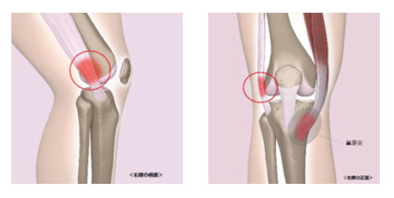 ランナー膝の症状